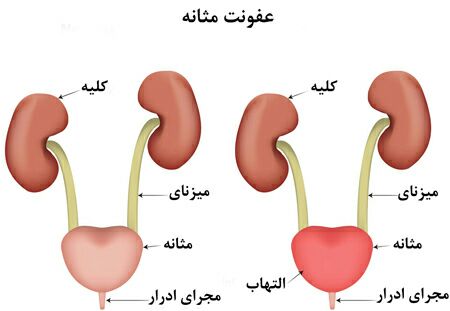 عفونت ادراری